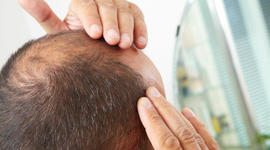 دراسة: الرجال الصلع أكثر عرضة للإصابة بكورونا