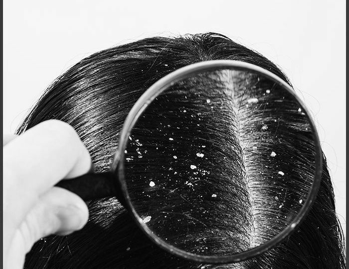 علماء: قشرة الرأس دلالة على مرض خطير