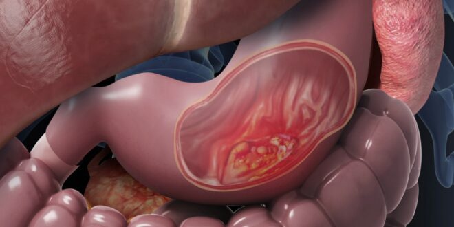 سرطان المعدة… الأعراض وطرق العلاج