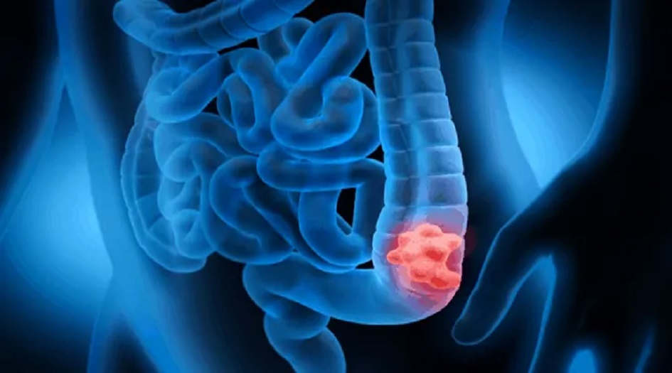 عادات الأمعاء غير الطبيعية قد تكون علامة على مرض مميت!