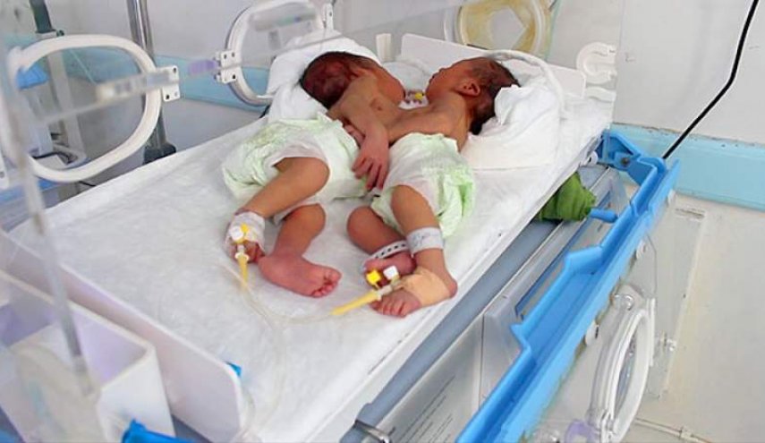 اليونيسف توافق على نقل التوأم السيامي للعلاج الى الخارج
