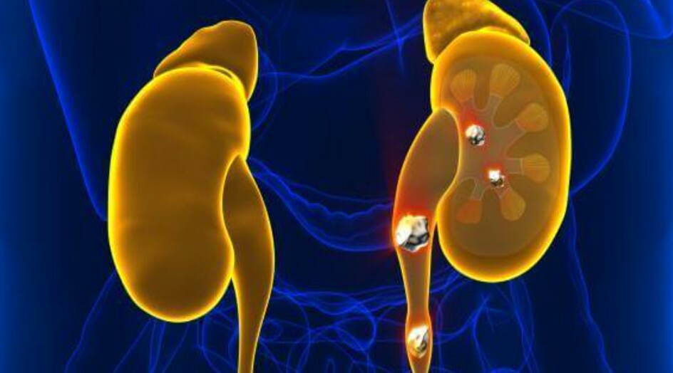 بمكونين من مطبخك .. وصفة خارقة لتفتيت حصى الكلى وتخفيف الألم