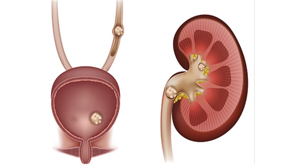 وداعاً للألم.. علاجات منزلية لحصى الكلى .. فعالة جدا