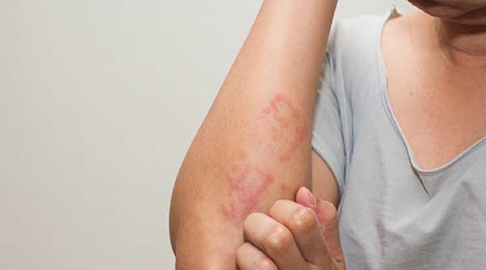 تعرف على أكثر الأطعمة إثارة للحساسية!