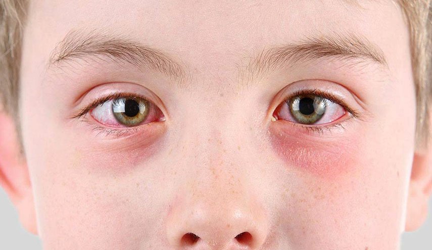 ما أسباب حرقان العين؟ وكيف تختار النظارة الشمسية المناسبة؟