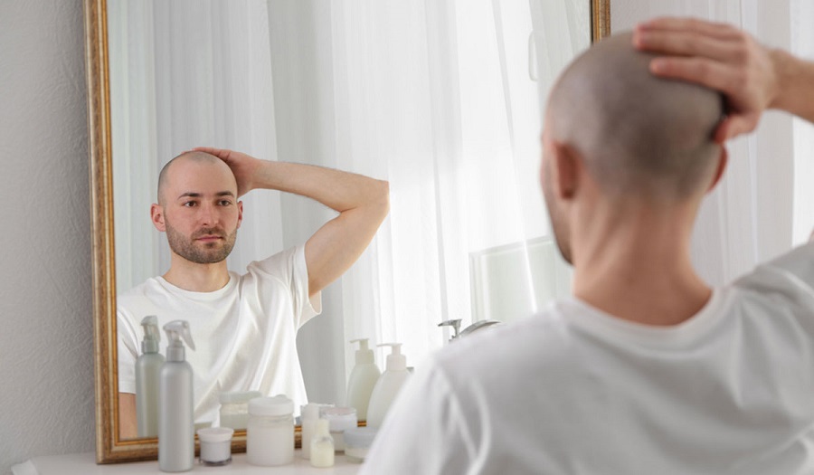 اكتشاف علاج طبيعي يقضي على الصلع