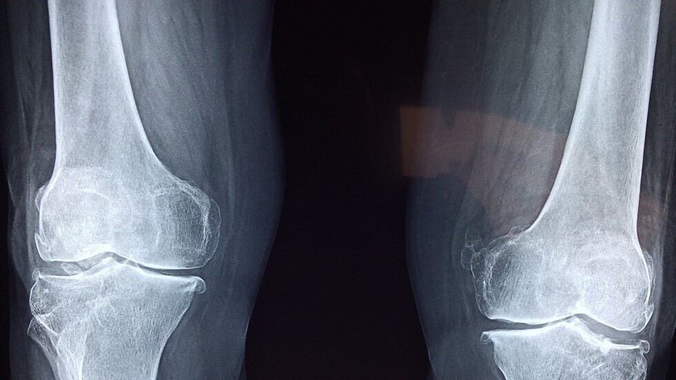 العلماء يستخدمون تقنية ثورية تحصد الخلايا الجذعية لعلاج العظام!
