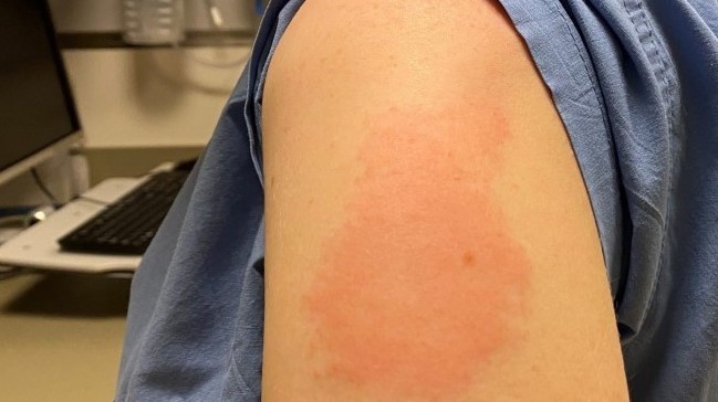كشف "السر" وراء الطفح الجلدي الأحمر بعد تلقي لقاح كورونا