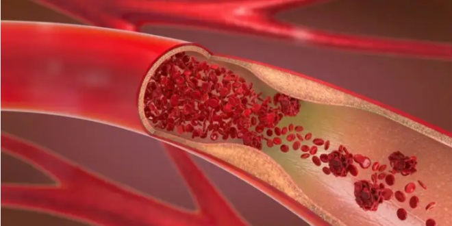 ما الفرق بين أعراض ارتفاع ضغط الدم وأعراض تصلب الشرايين