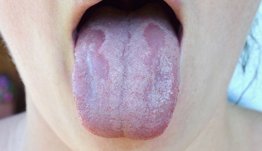 الفطر الأبيض يزيح الأسود.. ويخطر بمرض يشكل كارثة عالمية