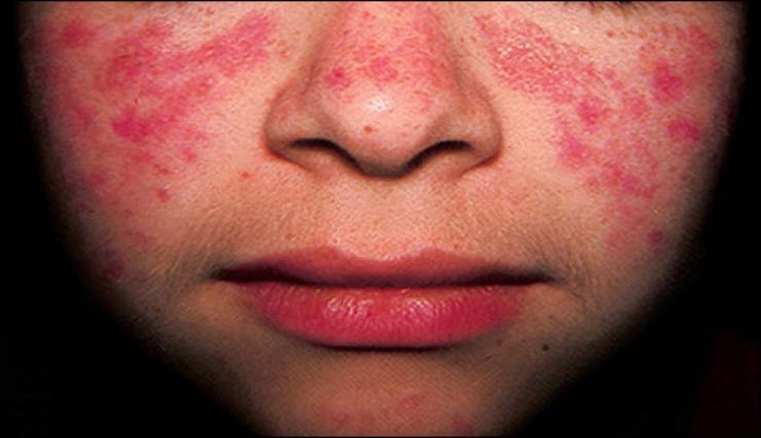 مرضى "جلد الفراشة" يسجلون شكوى ضد شركة تحظر الأدوية على إيران