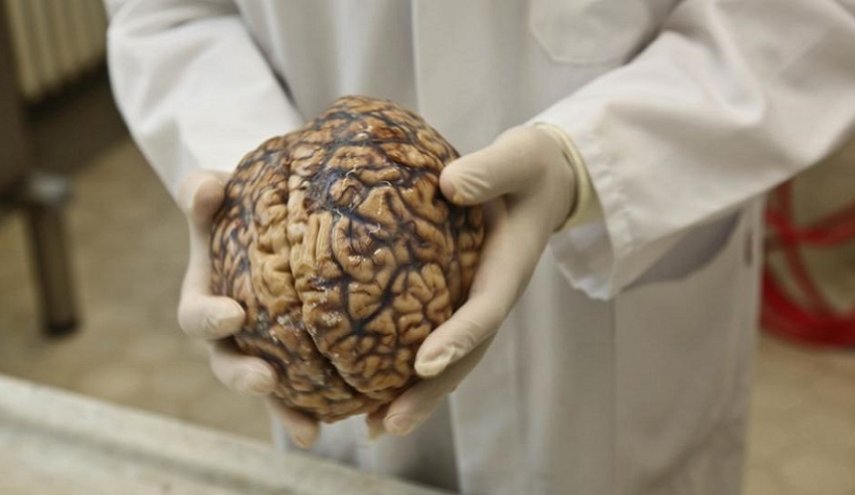 في اكتشاف غير متوقع.. هذا ما وجده العلماء في أدمغة مرضى ألزهايمر المتوفين!