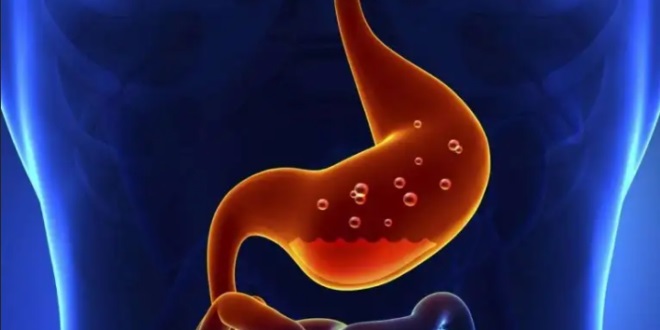 تجنبوها.. أسباب الإصابة بـ “عصب المعدة”