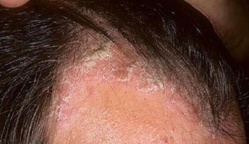 إلى الرجال.. احذروا هذه العلامة على رأسكم