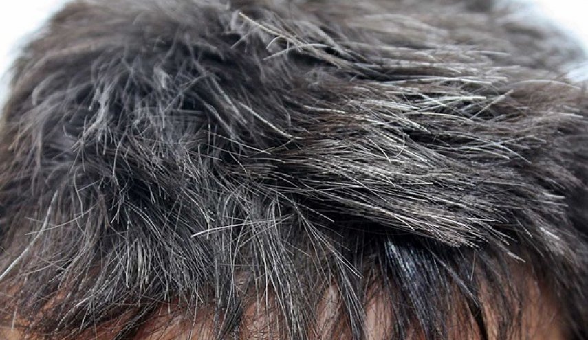 طبيب يشرح سبب شيب الشعر وطريقة تأخيره 