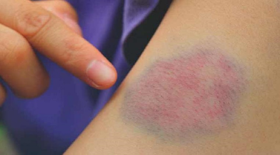 علامات لتجلط الدم على الذراع