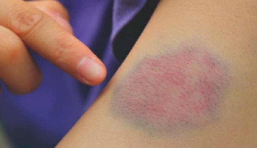 تعرف على علامات لتجلط الدم على الذراع