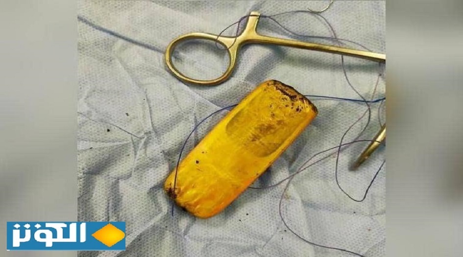 استخراج هاتف محمول من بطن مريض.. تعرف على القصة