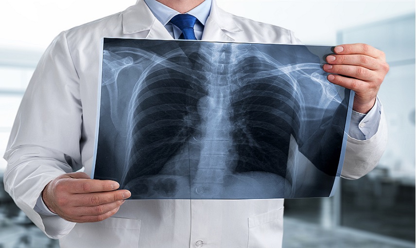 الكشف عن دواء لاستعادة العمل الطبيعي لرئتي الإنسان بعد أصابته بكورونا