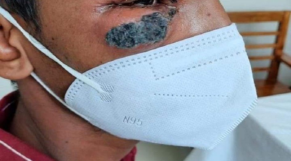 أعراض الفطر الأسود.. 18 علامة على الإصابة بالمرض