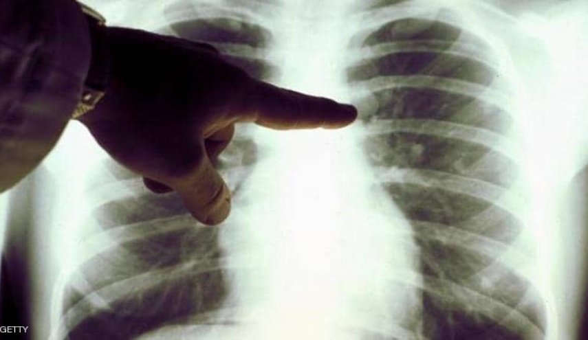 "جلطة دموية في الرئتين"..إحذر من هذه العلامات بأنماط التنفس!