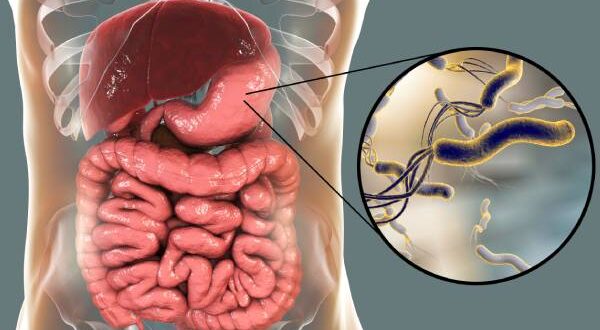 علاج جرثومة المعدة بالأعشاب الطبيعية والأدوية الموصوفة