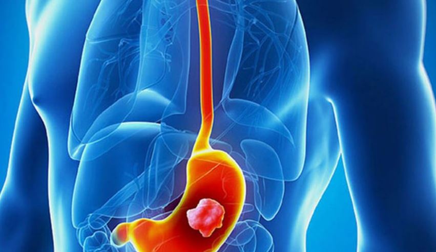 ما هو الطعام الذي قد يسبب الاصابة بسرطان المعدة؟