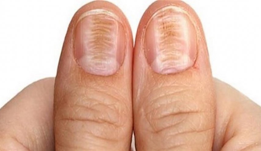  تغير لون الأظافر ينذر بالتسمم أو تليف الكبد  