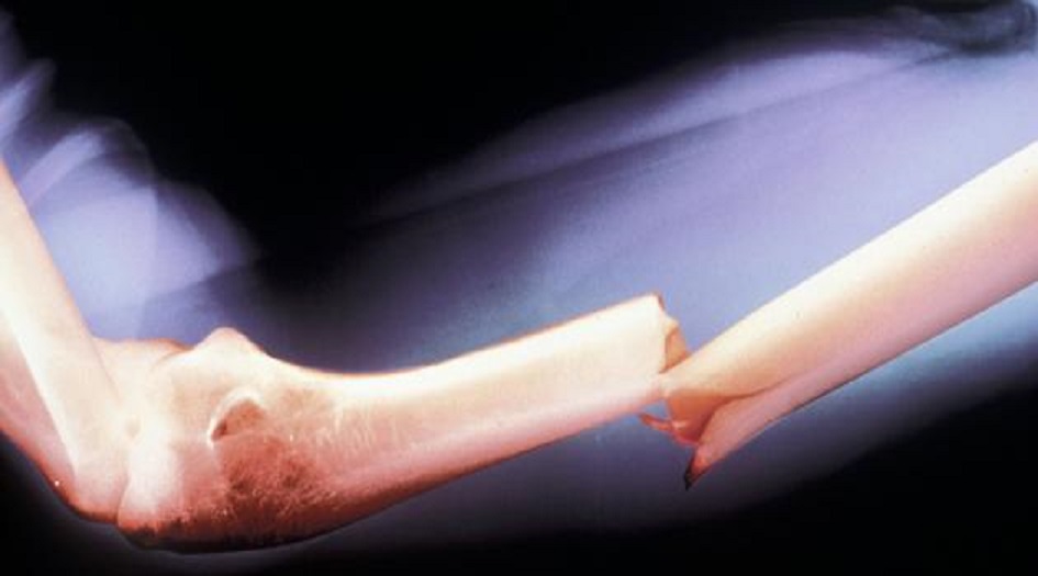 نصائح طبية للتعامل مع إصابات كسور العظام