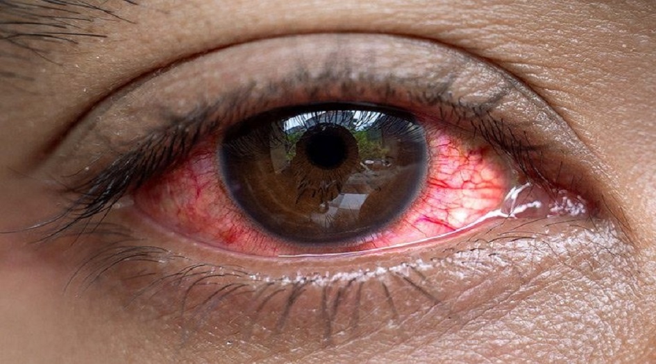 "جفاف العيون".. أسباب وطرق الوقاية منه!