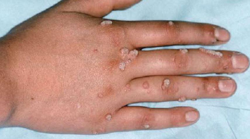 وباء جديد ينتشر في جميع أنحاء العالم