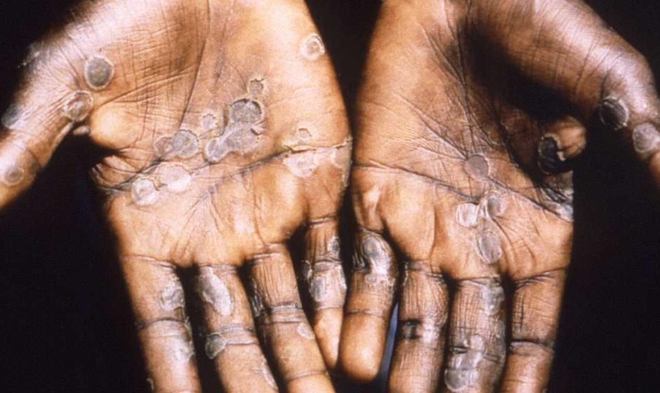 "لا لقاح له".. {جدري القردة} بكل تفاصيله وقلق عالمي