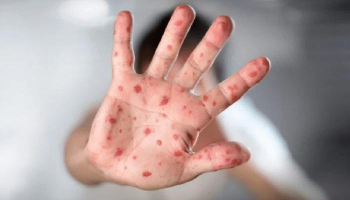  "جدري القردة".. دولة أوروبية تكشف معلومات مثيرة 