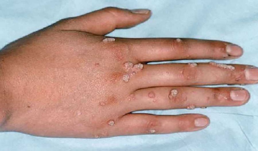 الصحة العالمية: حفلتان للمثليين قد تكون سبب انتشار جدري القردة في اوروبا