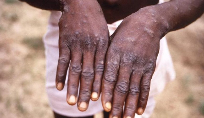 خبراء يُطمئنون: حالات الإصابة بجدري القرود نادرة عند الأطفال