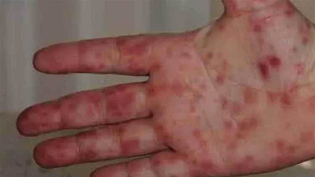  دولة عربية تكشف حقيقة "إنفلونزا الطماطم" 