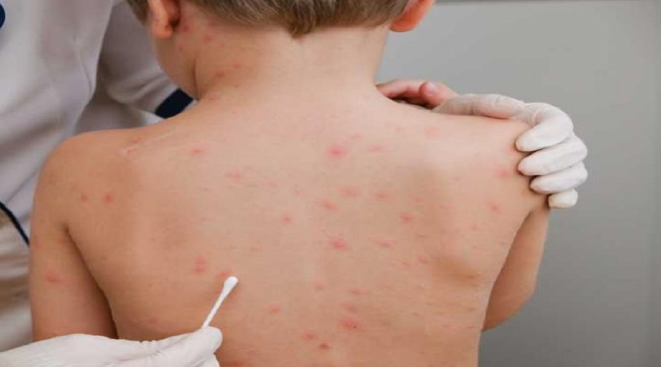 7 توصيات.. كيف تحمي نفسك من "جدري القرود"؟