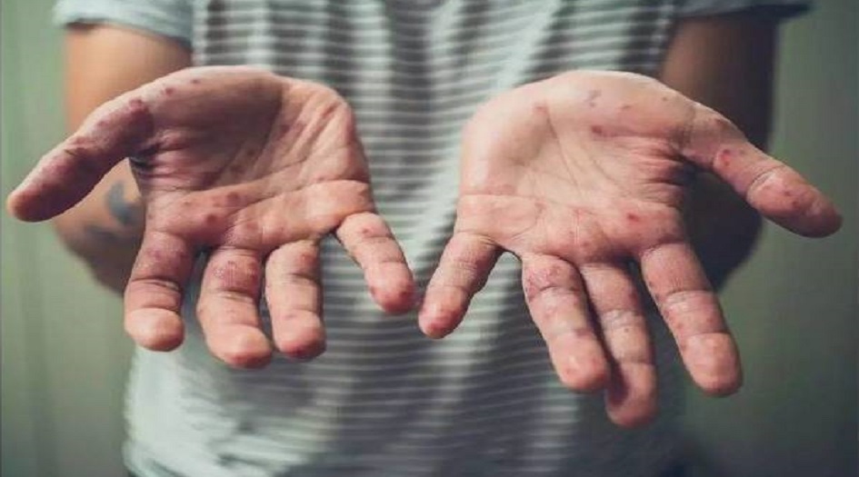 "الرقعة تتسع".. روسيا تسجل أول إصابة بجدري القرود