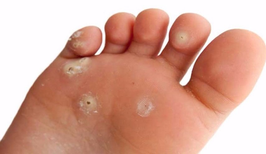  مسمار القدم... أسبابه وعلاجه