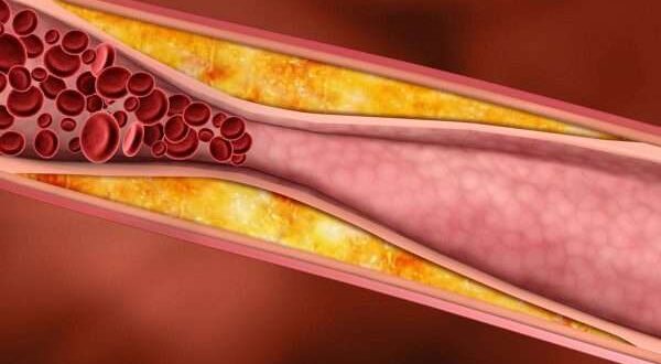 اسباب تصلب الشرايين .. وكيفية الوقاية منه وطرق علاجه