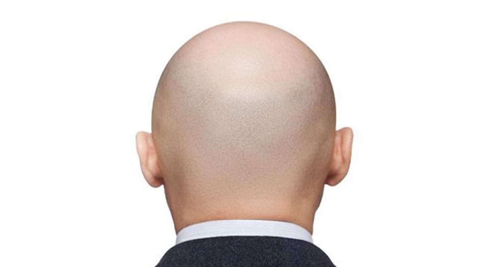  بشرى سارة لمن يعاني من الصلع 