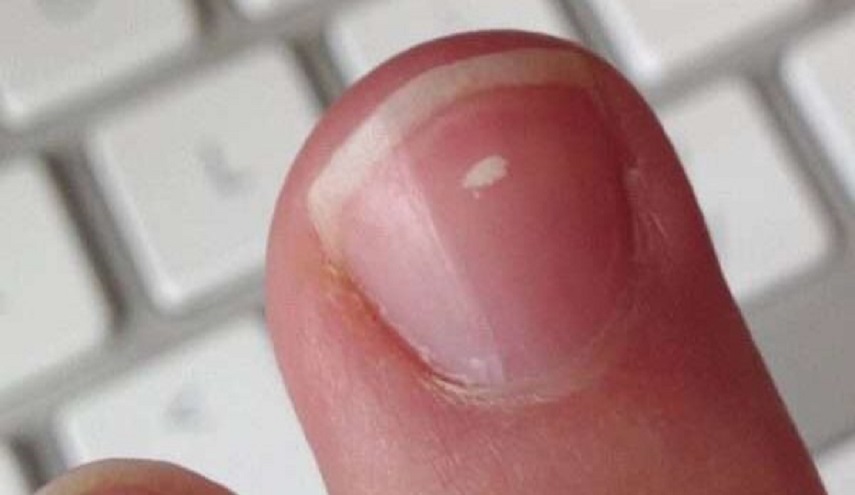 البقع البيضاء على الاظافر .. هل هي مؤشر خطر؟