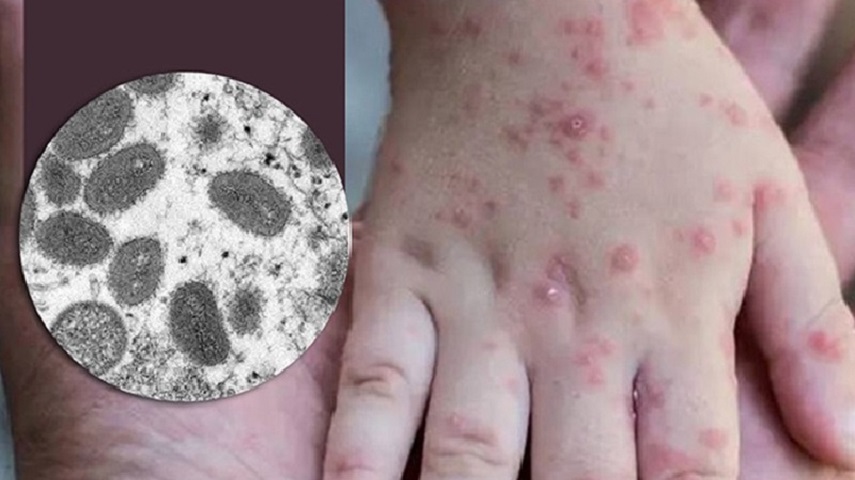 آبله ميموني چه علائمي دارد و چقدر طول مي‌كشد؟