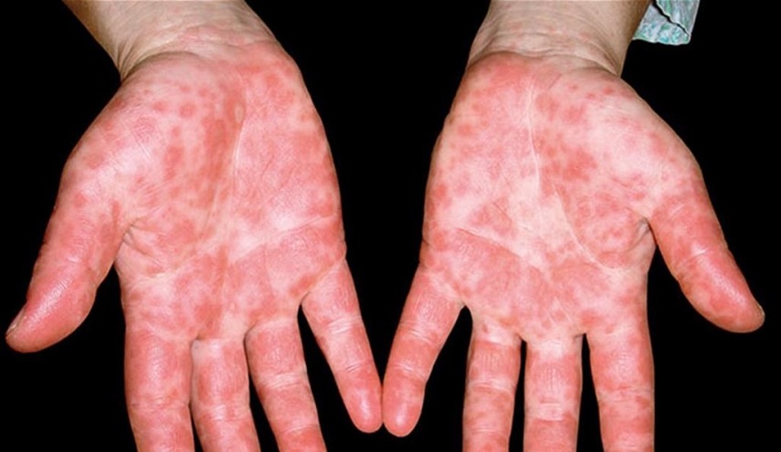 فيروس غامض يجتاح دولة آسيوية