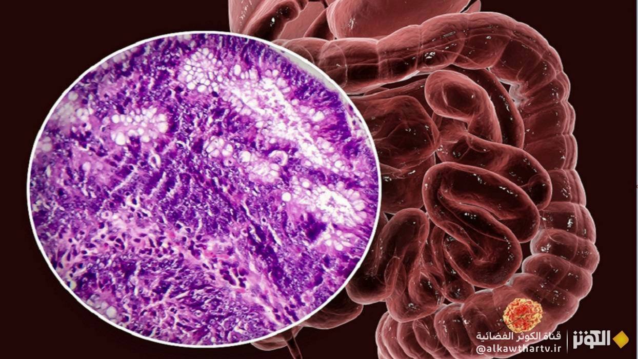  دراسة إيرانية واعدة لعلاج سرطان القولون 