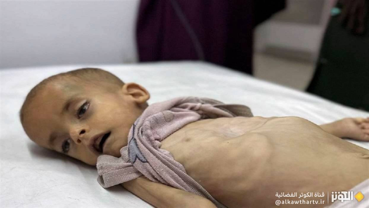  الصحة العالمية: وفيات سوء التغذية في غزة تشهد ارتفاعا مقلقا 