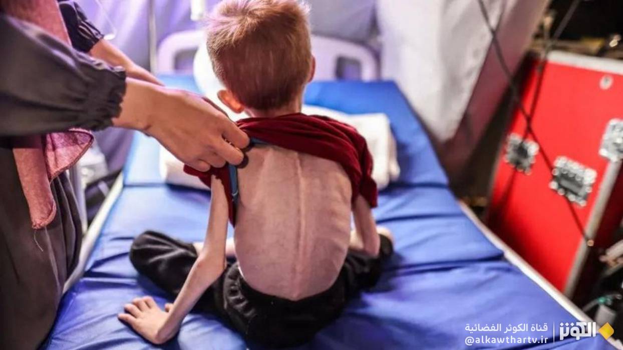 سوء التغذية يقتل 100 طفل في القطاع المحاصر